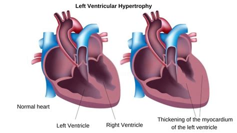 lv wall thickening|enlargement of left ventricle heart.